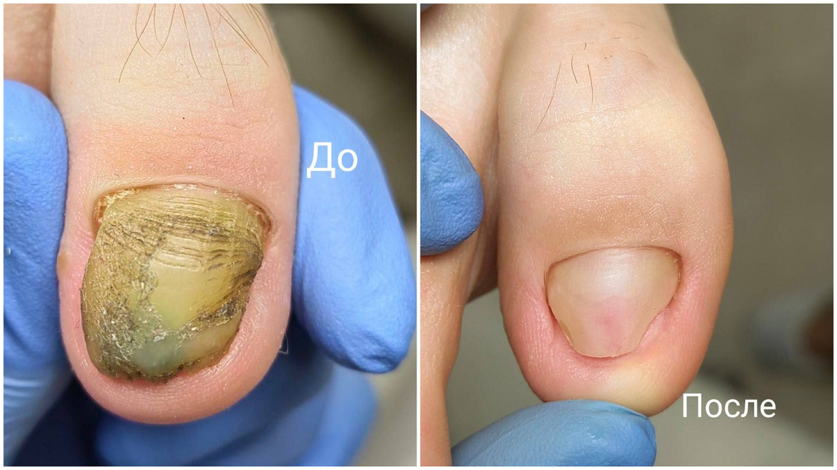 Динамика восстановления ногтевой пластины с диагнозом Экзостоз без хирургического вмешательства