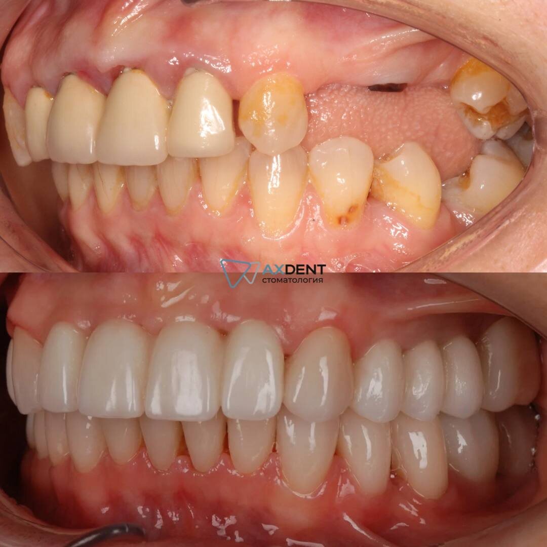 Пример тотального протезирования на имплантах с восстановлением десны