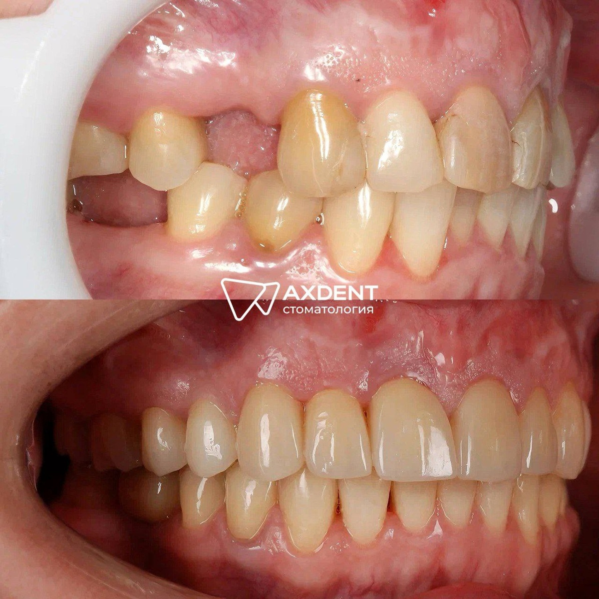 Коронка на импланте выглядит органично и естественно благодаря пластике десны