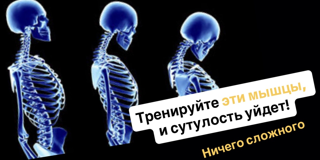 Какие мышцы нужно тренировать при сутулости