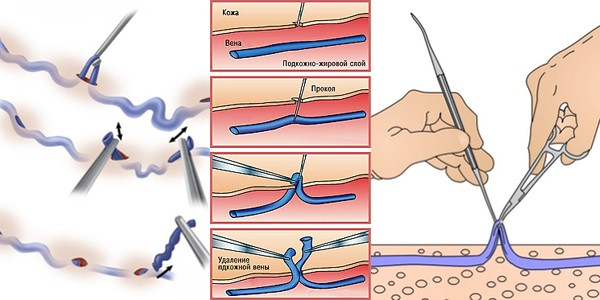 Но ключевое отличие – техника удаления вены. И здесь главную роль играет нить.
