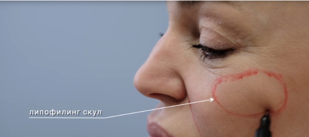 Процедура липофилинга скул