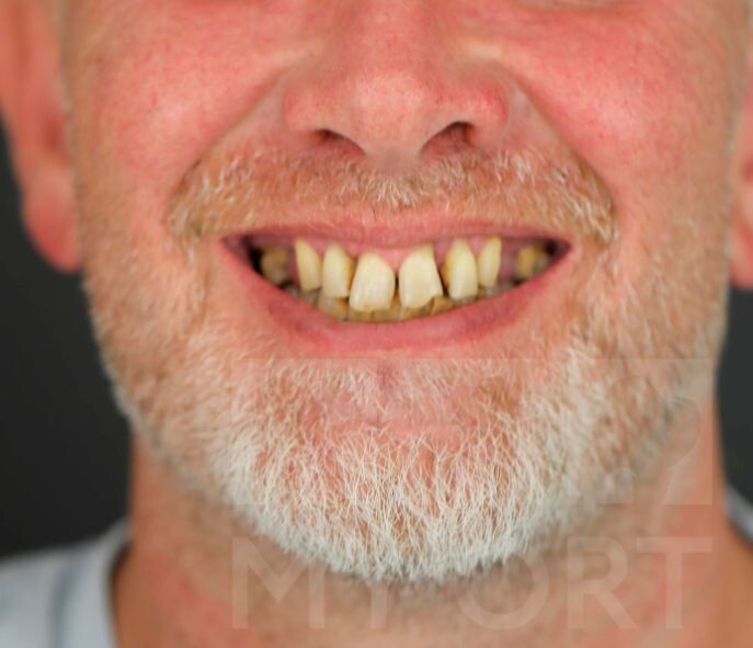 Состояние зубов пациента до лечения