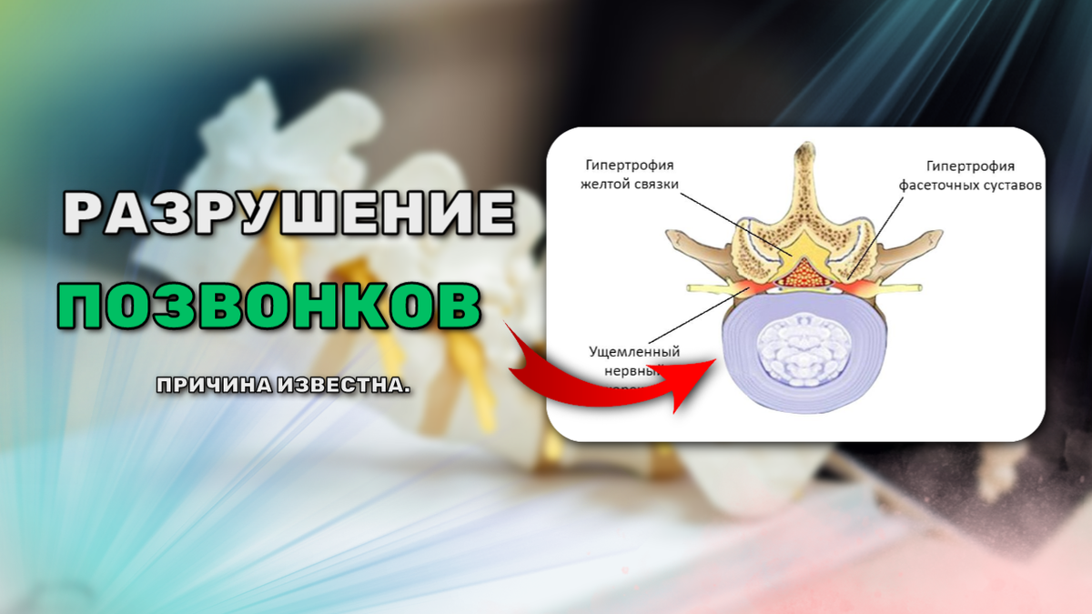 Дегенеративное заболевание межпозвоночных дисков