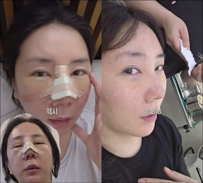    До и После ринопластики