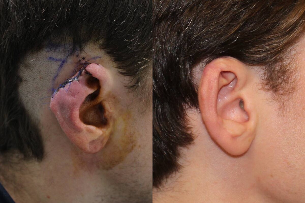 Фото до и после отопластики