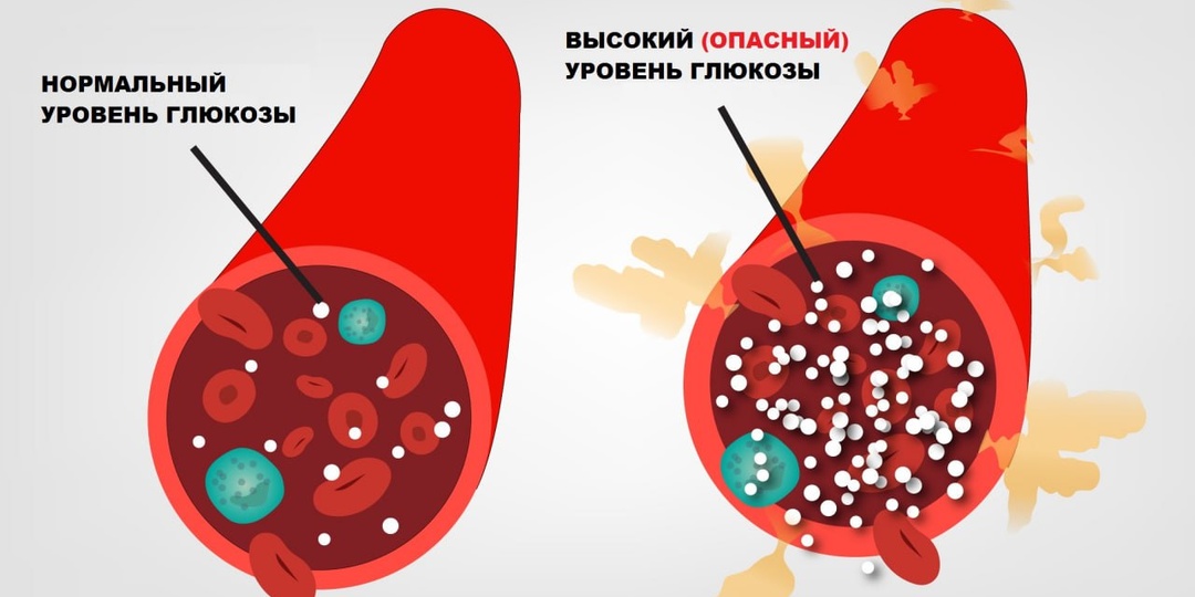 Когда сахар в крови нормальный, но диабет уже есть