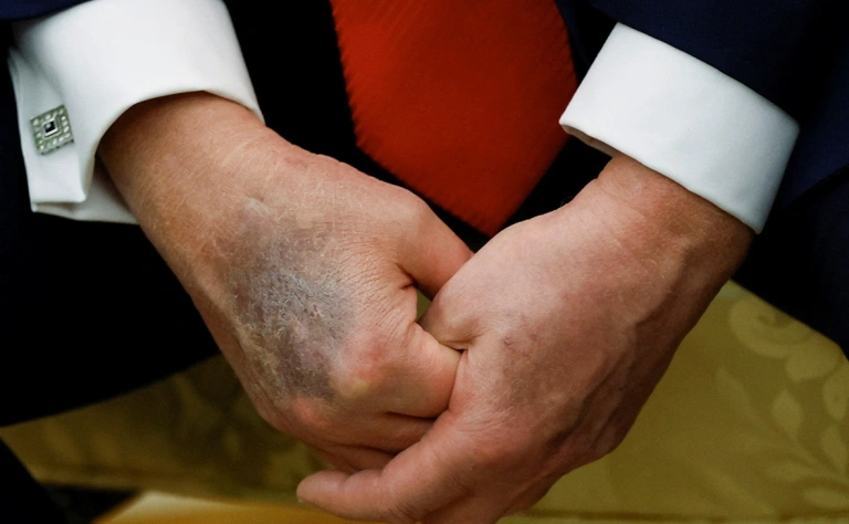 очередной синяк Трампа на правой кисти