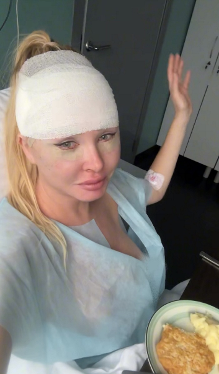Дарья Пынзарь с забинтованной головой после операции. Фото: соцсети