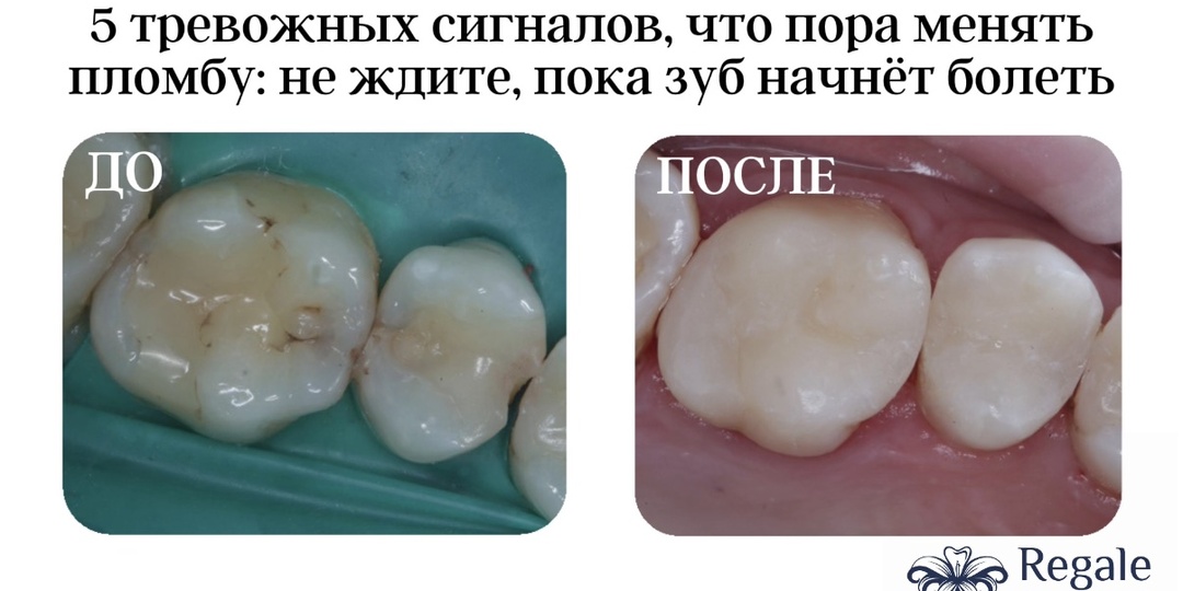5 тревожных сигналов, что пора менять пломбу: не ждите, пока зуб начнёт болеть