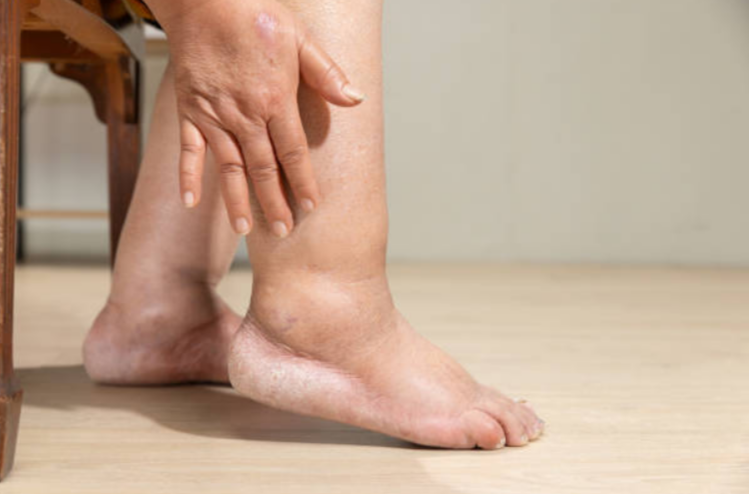 Отеки как сигнал болезней. Каких?