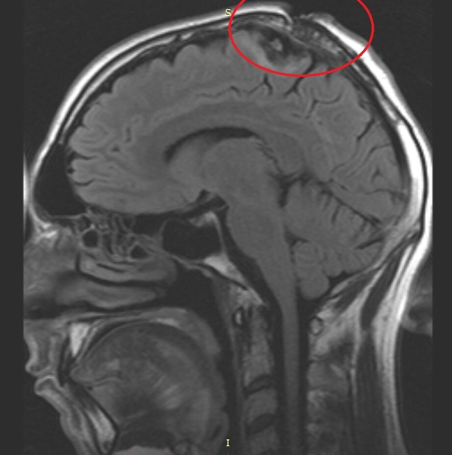 МРТ головы в боковой проекции. На МРТ-снимке визуализируются последствия боевого ранения: металлический осколок и костные фрагменты в теменной области слева (практически по продольной щели головного мозга). При таком серьезном ранении твердая мозговая оболочка осталась неповрежденной — это во многом определило тактику лечения.