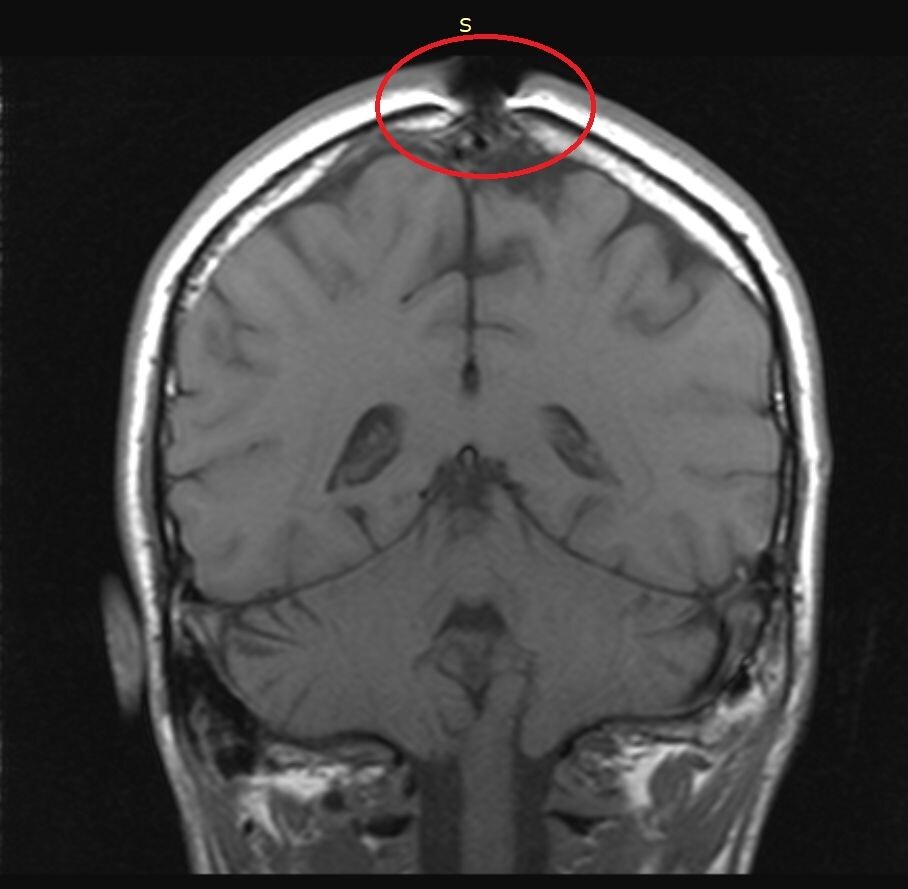МРТ головы в прямой проекции.
