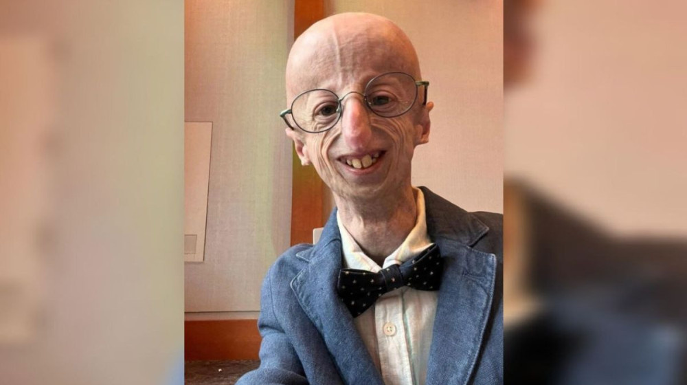    Как выглядит девочка с лицом старухи спустя 25 лет и что с её детьми – невероятная история Екатерины