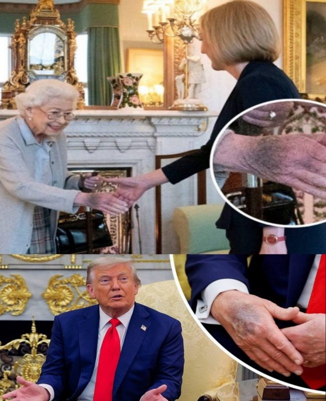    Руки Трампа сравнили с руками английской королевы. За несколько месяцев до смерти у неё были такие же гематомы.