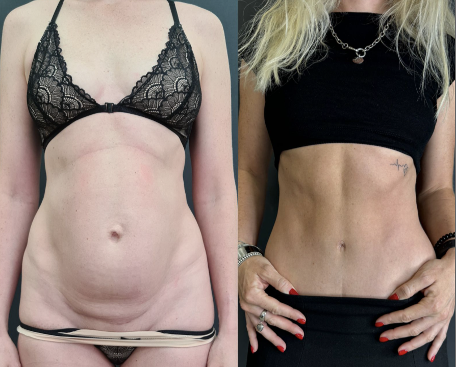 Абдрминопластика / https://vladimirzlenko.ru/portfolio#Abdominoplasty4
