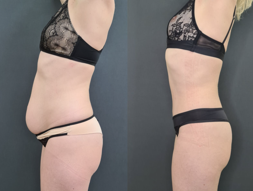 Абдоминопластика: до и после / https://vladimirzlenko.ru/portfolio#Abdominoplasty4