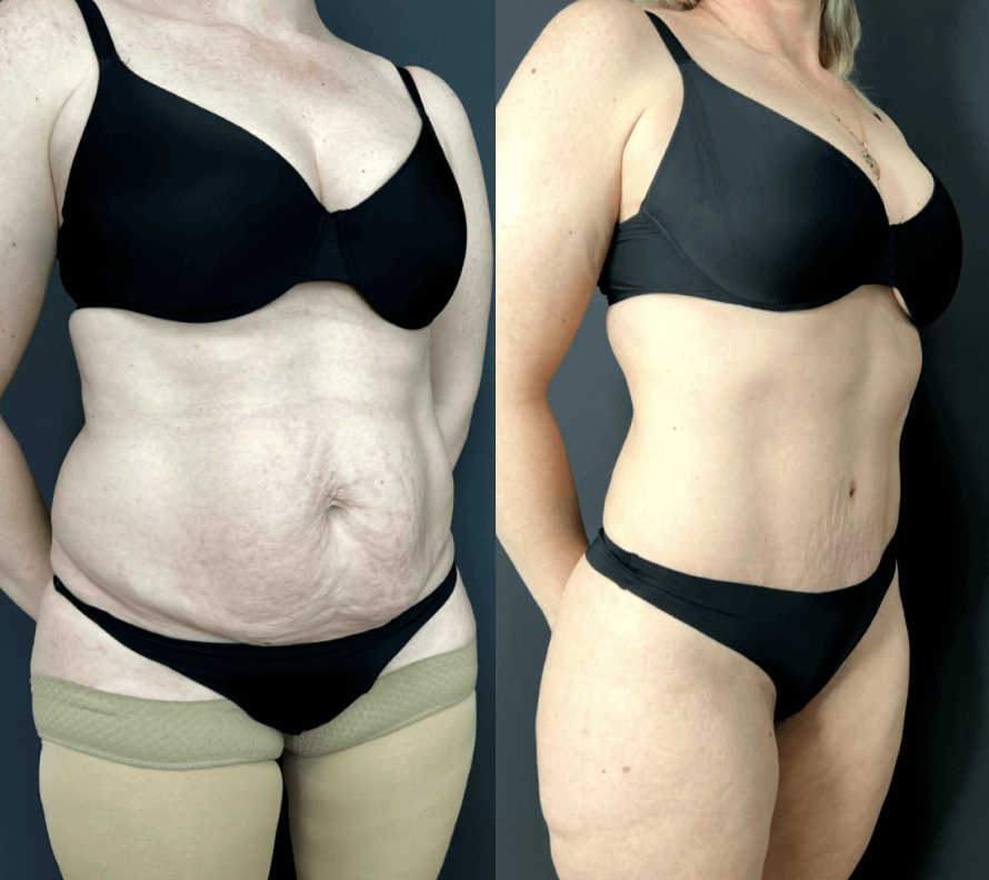 Абдоминопластика с липосакцией живота и спины / https://vladimirzlenko.ru/portfolio#liposuction2