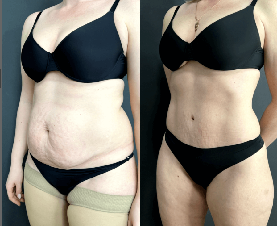 Абдоминопластика с липосакцией живота и спины / https://vladimirzlenko.ru/portfolio#liposuction2