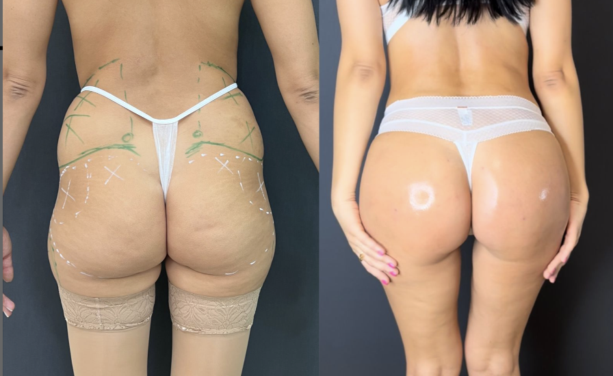 Липофилинг ягодиц / https://vladimirzlenko.ru/portfolio