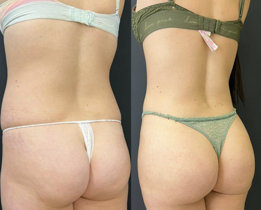 Липофилинг ягодиц / https://vladimirzlenko.ru/portfolio