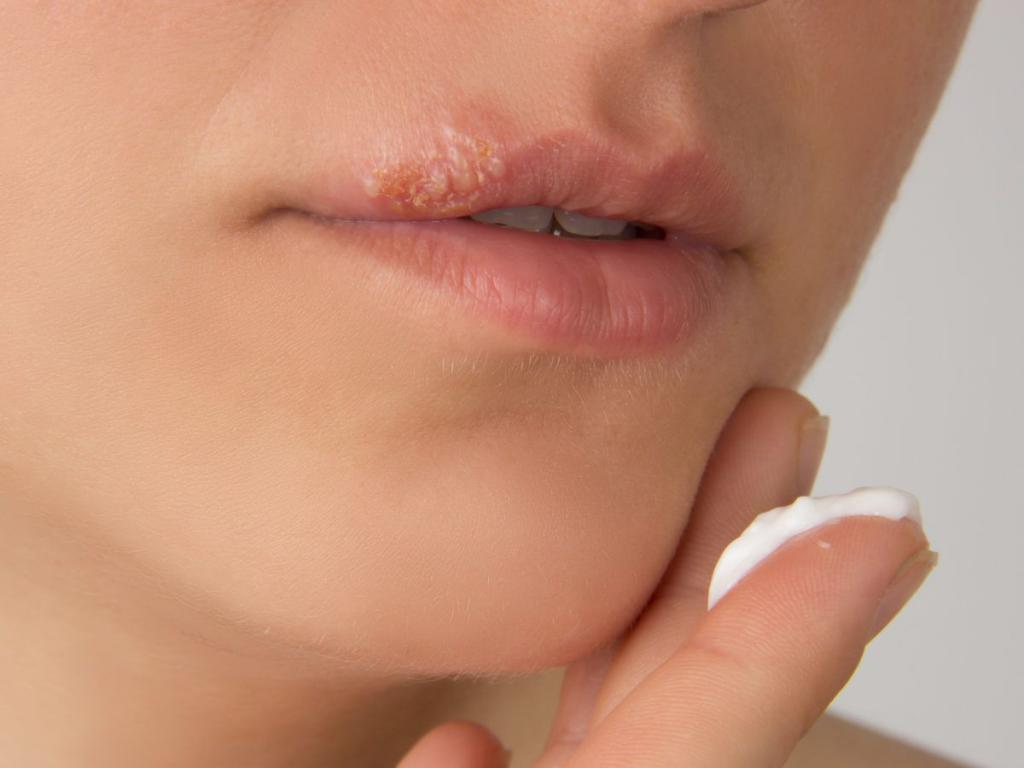 Герпес на верхней губе