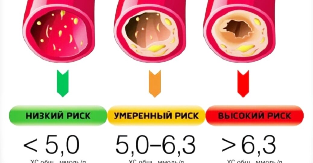 Как узнать, что сосуды уже «забиты». 7 неявных признаков атеросклероза