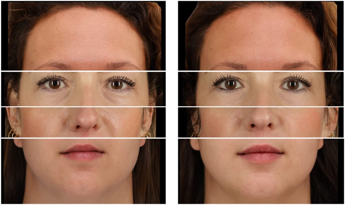    Примеры изображений (слева — до процедуры, справа — после), которые показывали испытуемым. В тексте исследования иллюстрацию составили из четырех фрагментов фото разных людей, чтобы обеспечить анонимность. В экспериментах этот прием не использовали: лицо на каждом снимке было едиными и принадлежало какому-то одному человеку / © Jaeger, B., Bucker, B. et al., Perception (2025)