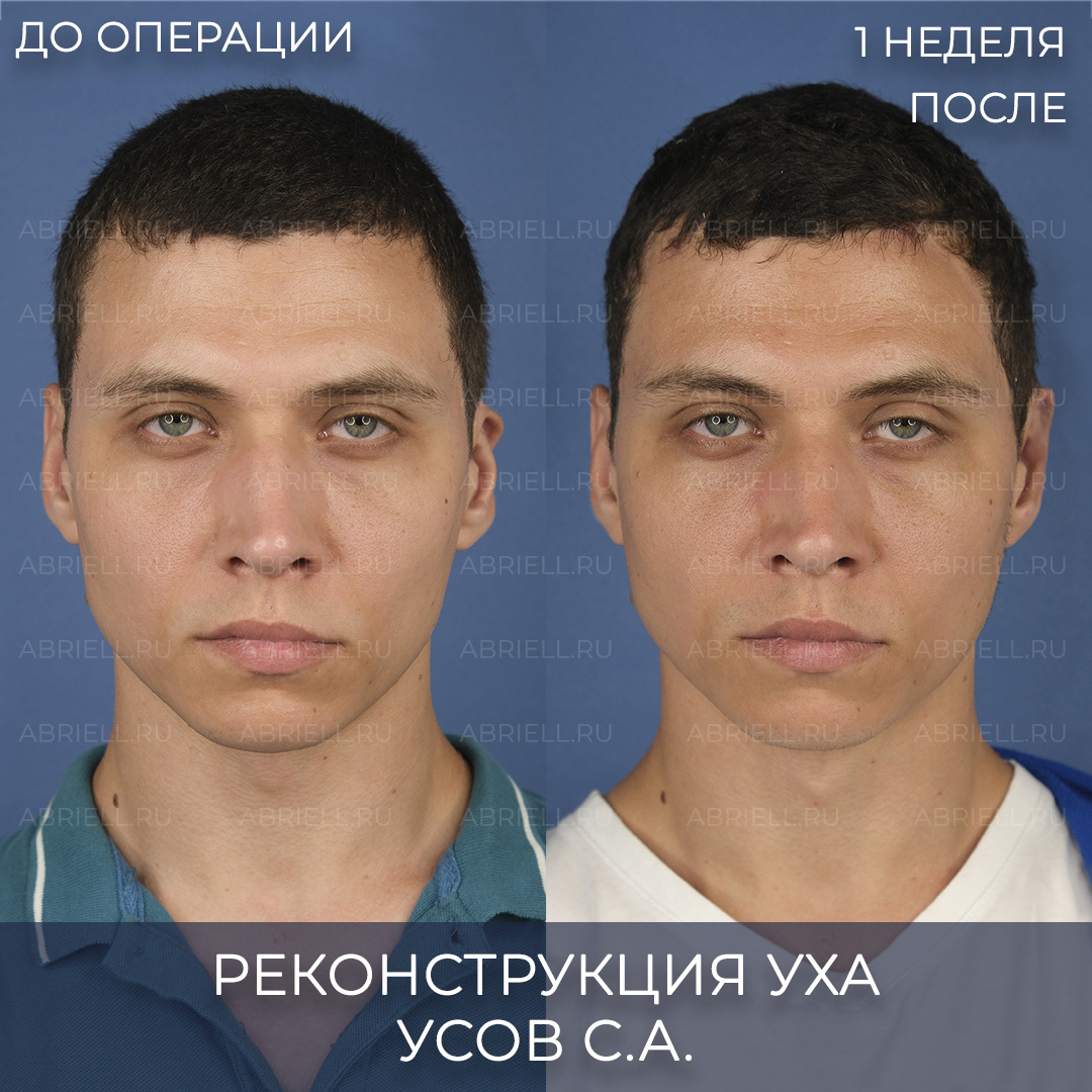 Реконструкция ушной раковины. Пластика ушей. Отопластика в Санкт-Петеребурге. Пластический хирург Усов Семен Алексендрович клиника Абриелль 