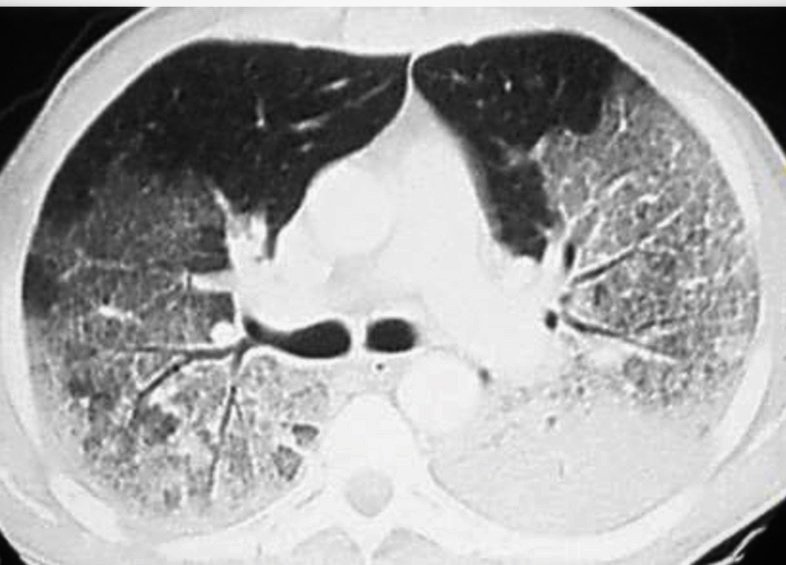 КТ ОГК на уровне бифуркации трахеи, аксиальный срез: пневматизация лёгочной ткани выраженно снижена за счёт диффузно расположенных участков "матового стекла" и консолидации, преимущественно локализующихся в дорсальных и базальных отделах лёгких (эффект градиента).