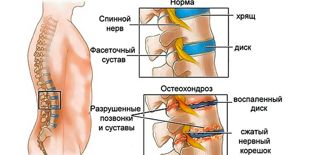 Остановите боль в спине: простые способы предотвратить остеохондроз