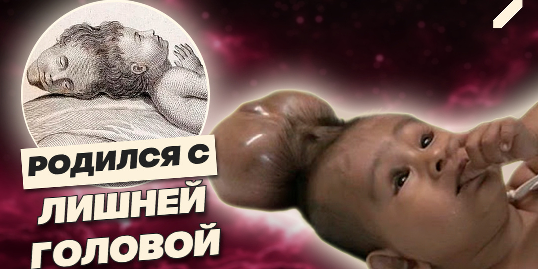 Мальчик с двумя головами: чудо природы или биологическая ошибка
