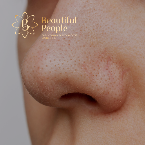 Расширенные поры на лице требуют особый уход