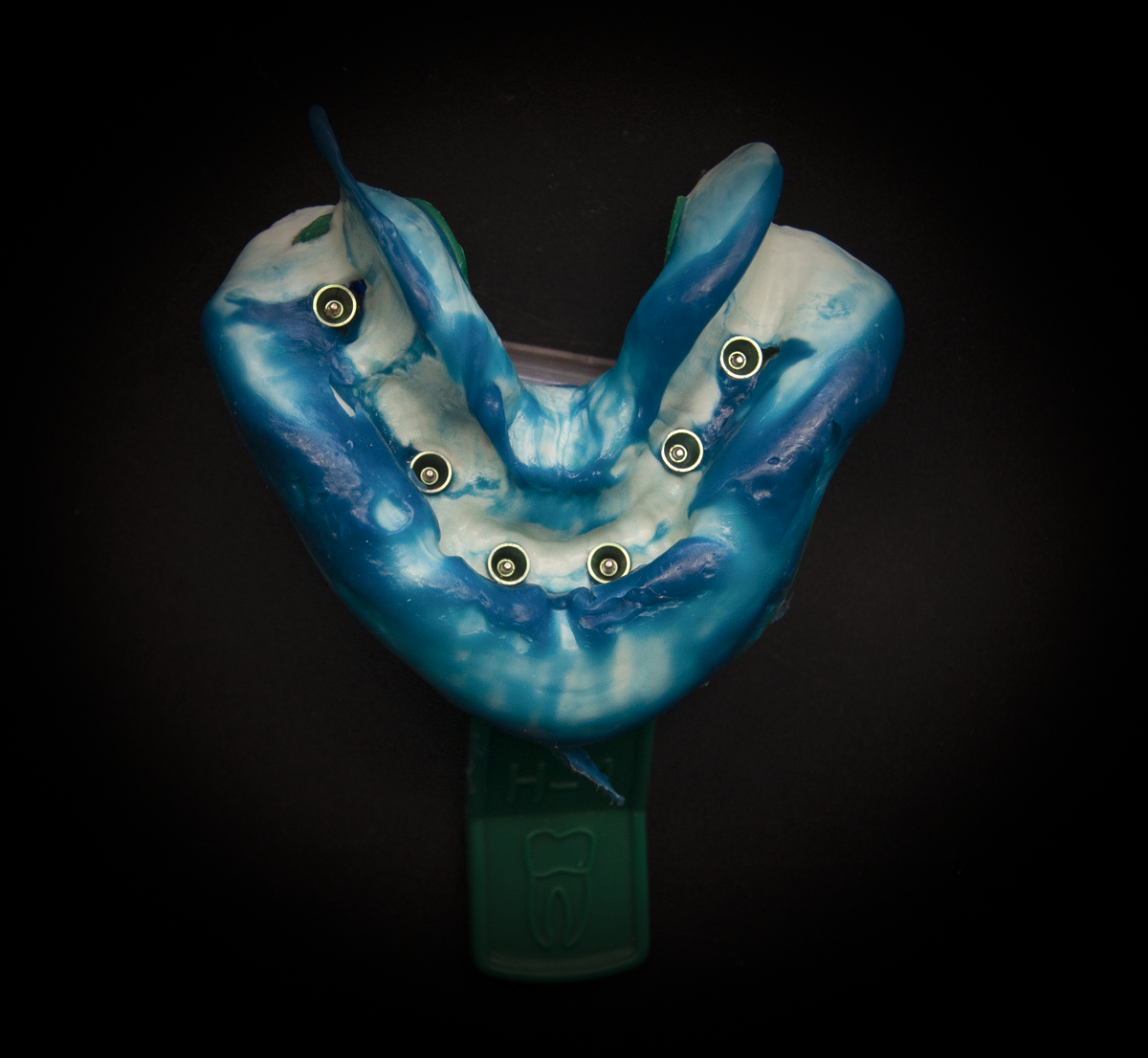 Слепок рабочий, первоначальный под индивидуальную ложку, трансфер-чеки. Нижняя челюсть.