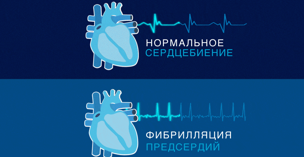 Лечение фибрилляции предсердий: стратегии и тактики
