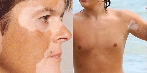 Почему появляются белые пятна на коже? Разбираемся в причинах витилиго