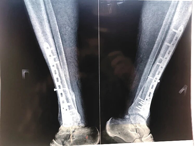 При падении Михаил Казаков сломал обе ноги и раздробил кости.