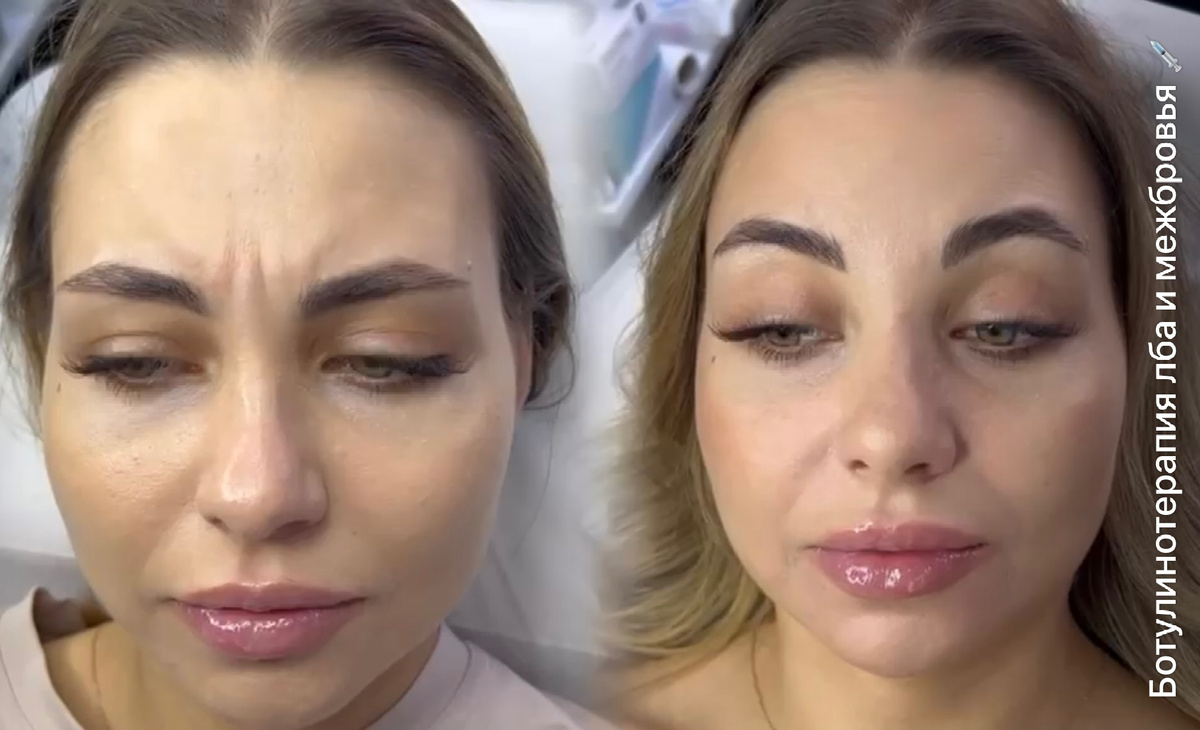 Зоны коррекции: лоб и межбровье