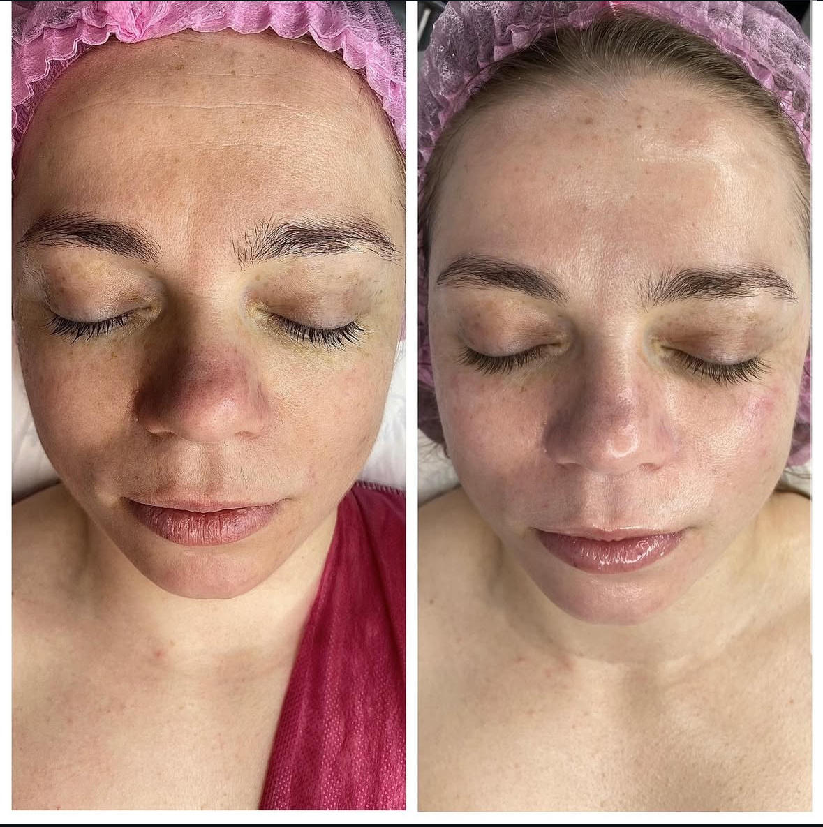 Было сделано 4 процедуры пилинга Prx-t33 , 1 раз в 7-10 дней