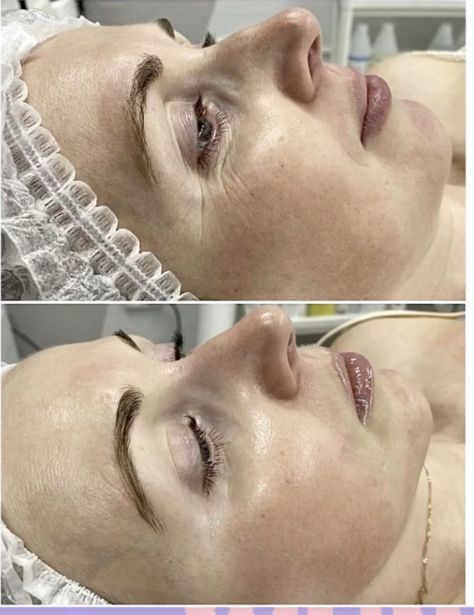 5 процедур фракционной мезотерапии: делали сыворотки с гиалуроновой кислотой для увлажнения, с витамином С для осветления и витаминизирования, с пептидами для разглаживания морщин. состав подбирается индивидуально.