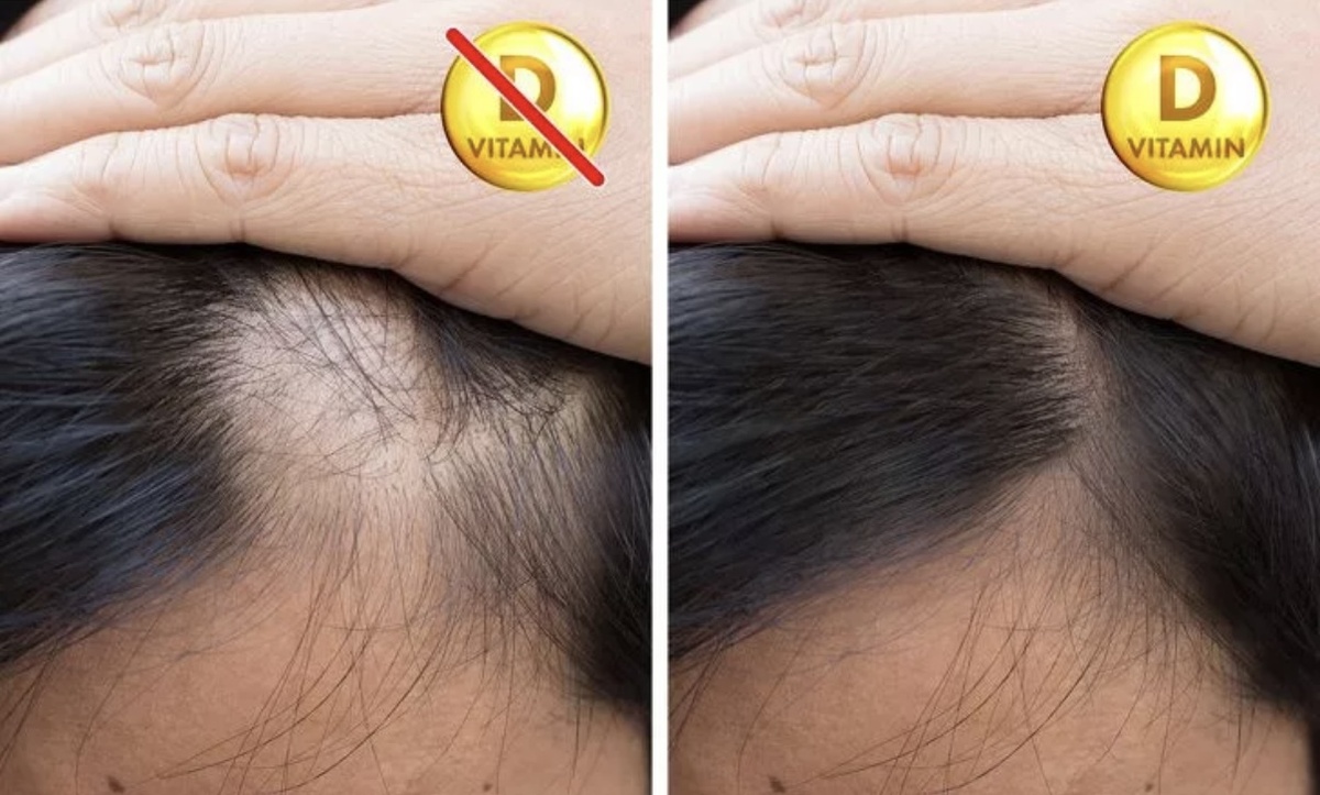 Витамин D и выпадение волос ..🥲