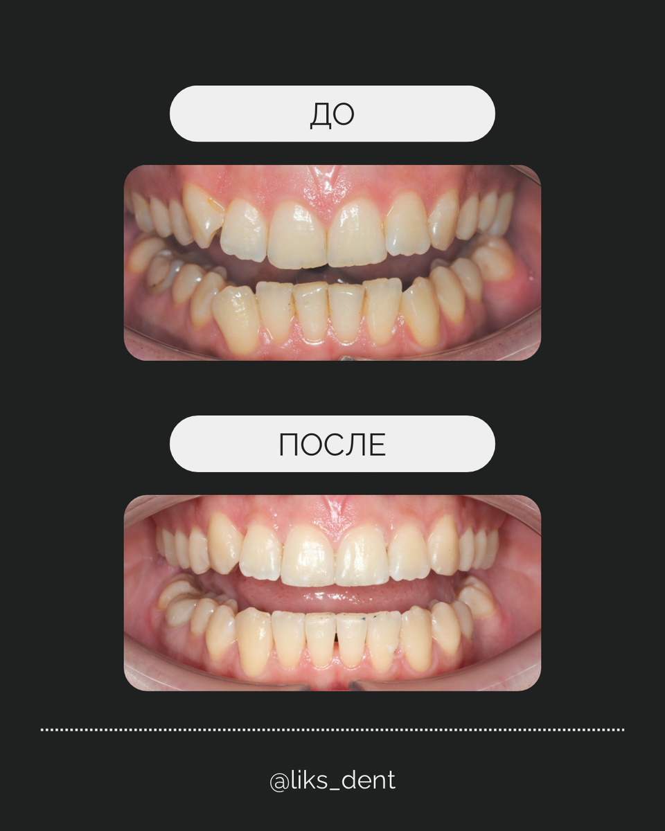 До/после ортодонтическое лечение 