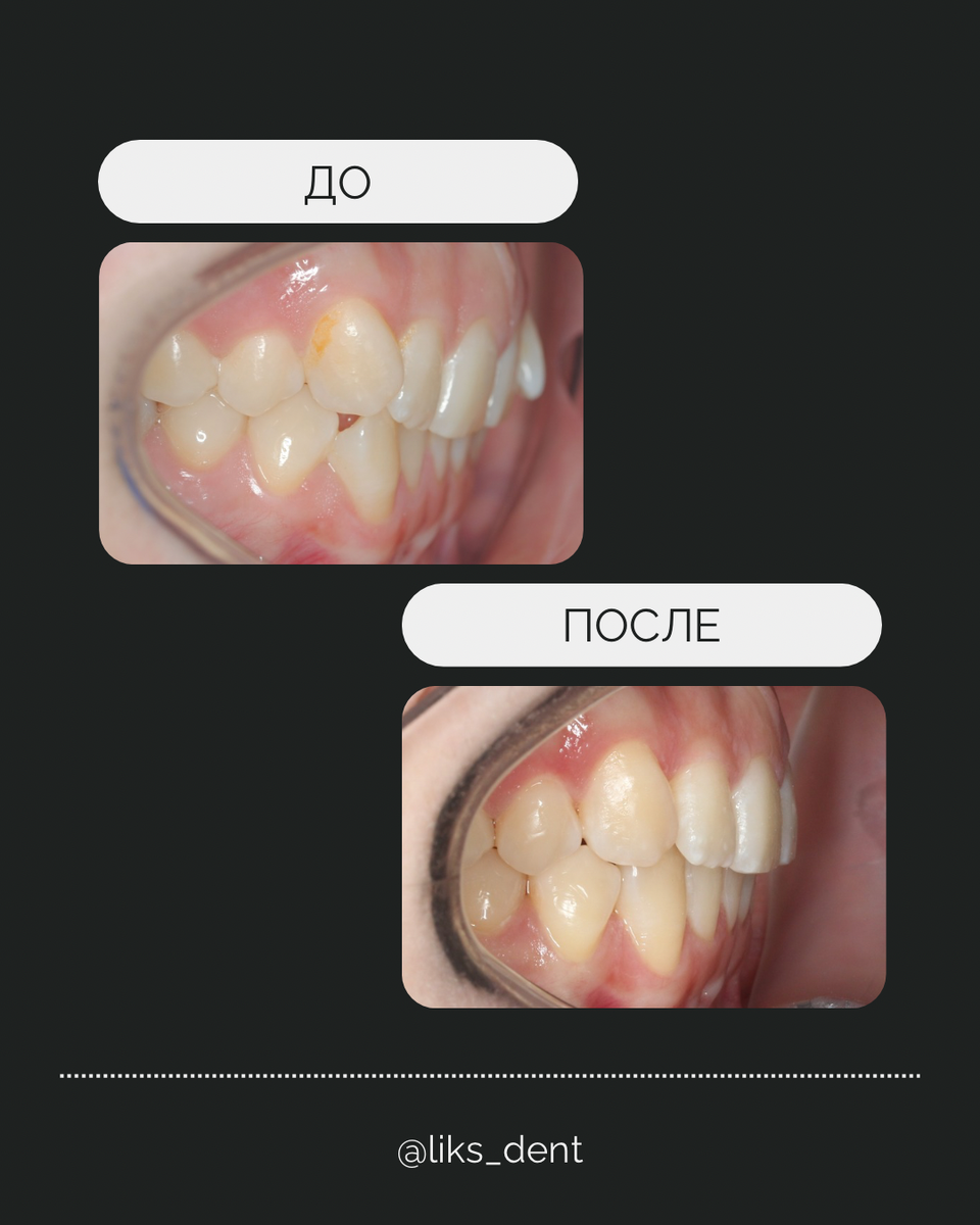 До/после ортодонтическое лечение 