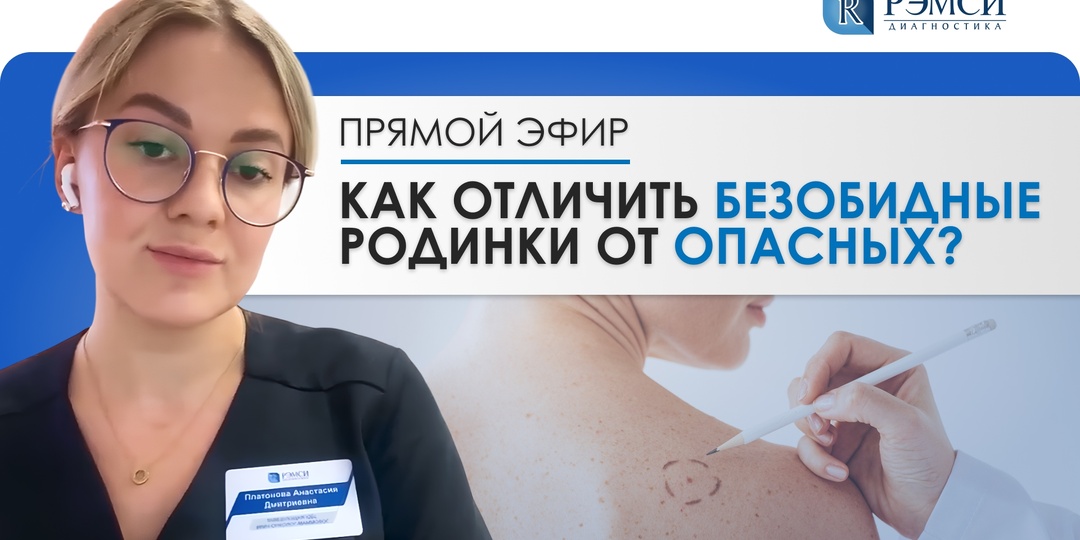 Как отличить безопасную родинку от меланомы: руководство по раннему распознаванию