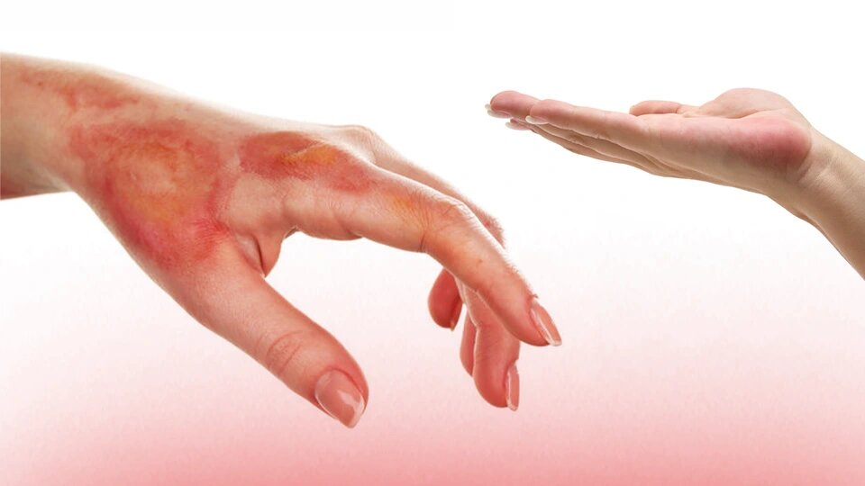 Ожоги: что делать и что категорически нельзя. Наука против мифов