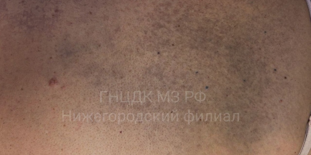 Редчайшую жуткую патологию выявили у нижегородки