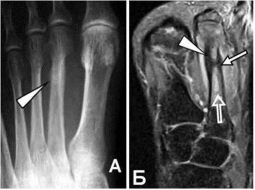 Стрессовый перелом на рентгенограмме (А) и МРТ (Б).