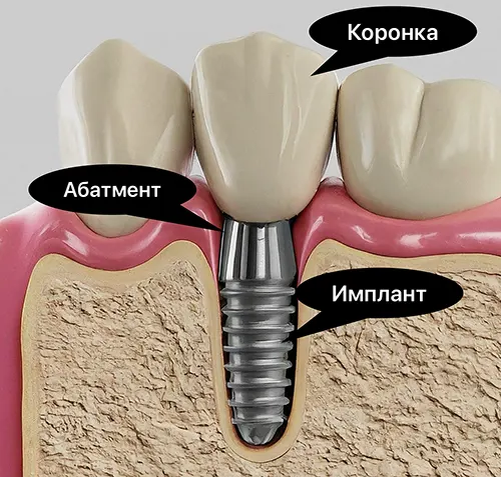 Зубной имплант может прослужить и 30 лет, но на это влияет много факторов.