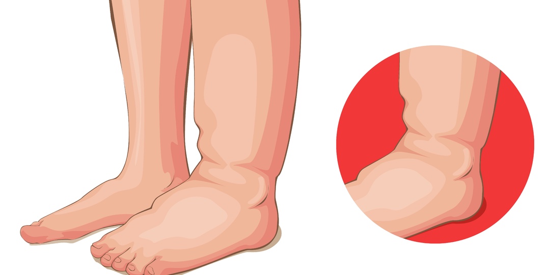 Когда ноги отекают — это не почки: причины, симптомы и что делать