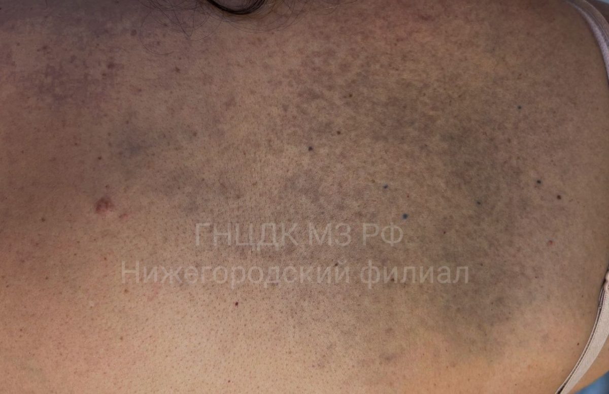    Специфического лечения для невуса нет, но новообразование можно скрыть косметически или лазерным осветлением